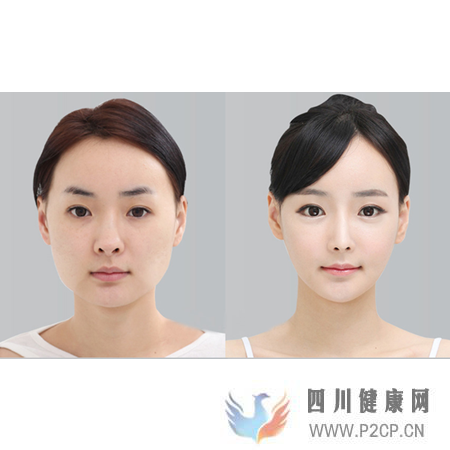 美容整形前一定要知道的美容整形知识(图8) 美容整形前一定要知道的美容整形知识(图8)