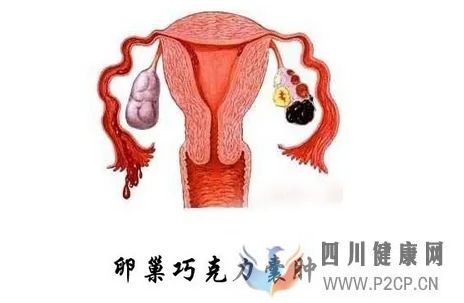巧克力囊肿应该怎样治疗呢?(图1) 巧克力囊肿应该怎样治疗呢?(图1)