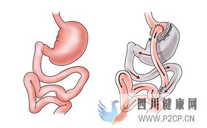 胃旁路手术治疗肥胖型2型糖尿病效果怎么样(图1)