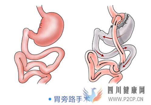 糖尿病治疗：腹腔镜胃旁路术效果怎么样？(图1)