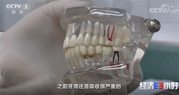 干细胞注射长出牙槽骨，牙齿再生或成现实！网友：我的牙有救了(图1)