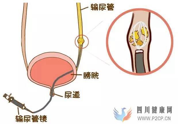 得了肾结石怎么治疗比较好？(图1)