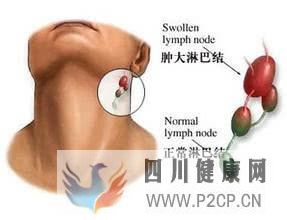 淋巴结肿胀是怎么回事引起淋巴结肿大的原因有哪些(图2)