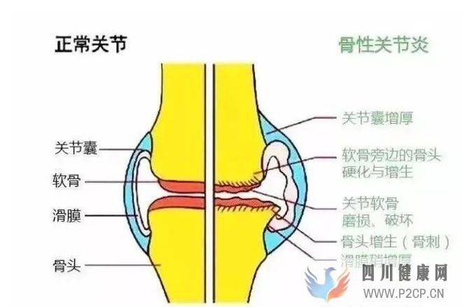 干细胞移植有效治疗膝骨关节炎！(图1)
