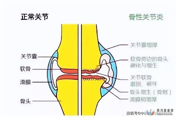 中科西部细胞：干细胞移植有效治疗膝骨关节炎！(图1)