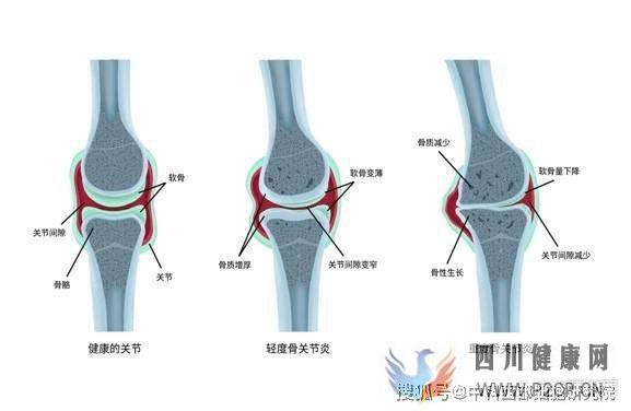 中科西部细胞：干细胞膝关节注射(图1)