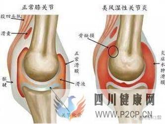 中科西部细胞：干细胞膝关节注射(图2)