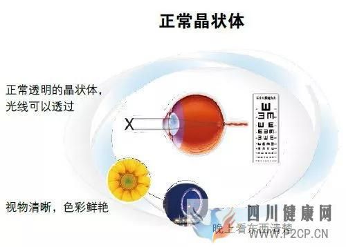 北京首大施玉英：得了白内障有什么感觉？白内障手术的最佳时间是什么时候(图1)