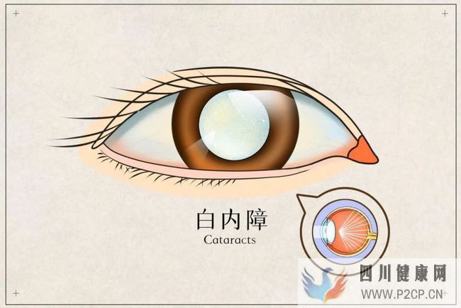 白内障逐渐年轻化,是什么原因导致的?(图1) 白内障逐渐年轻化,是什么原因导致的?(图1)