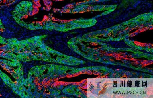 阻断蛋白质的生物合成或有望遏制癌症干细胞的功能(图1) 阻断蛋白质的生物合成或有望遏制癌症干细胞的功能(图1)