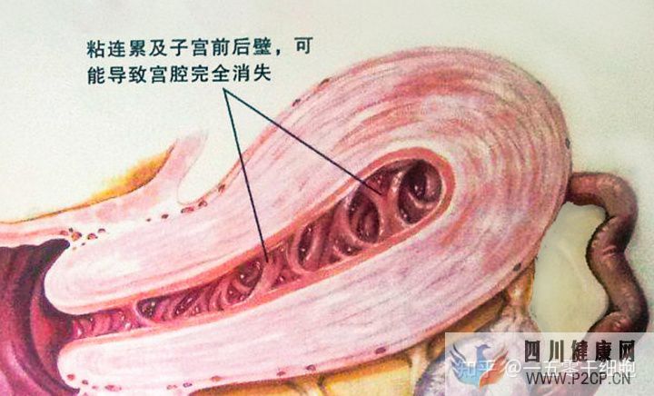 干细胞的4大作用,帮助修复宫腔粘连所致的子宫内膜...(图1)