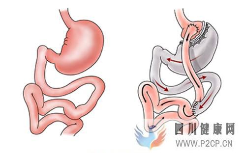 打败糖尿病传统治疗法？胃旁路手术真的这么厉害吗(图1)