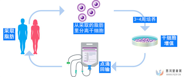 日本干细胞慢性肾脏肾功能不全如何治疗日本干细胞治疗流程介绍(图3)