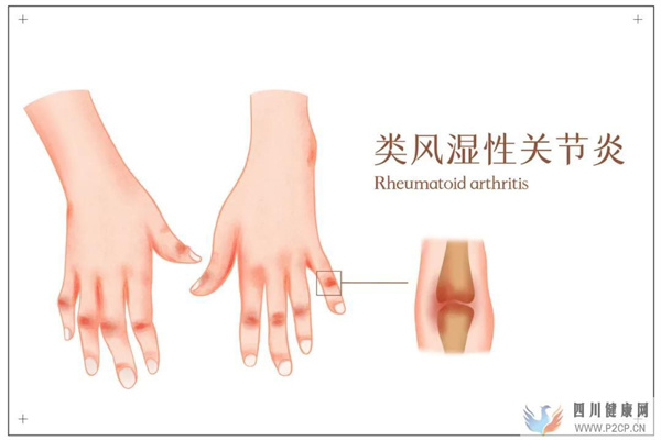 科普丨效果显著!间充质干细胞应用于多项临床疾病治疗(图6) 科普丨效果显著!间充质干细胞应用于多项临床疾病治疗(图6)