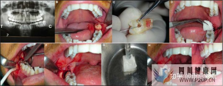 牙髓干细胞应用进展-摘取(图5)