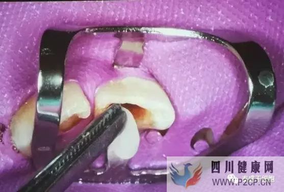 首创牙髓再生术,创造了乳牙干细胞的新里程碑(图13)