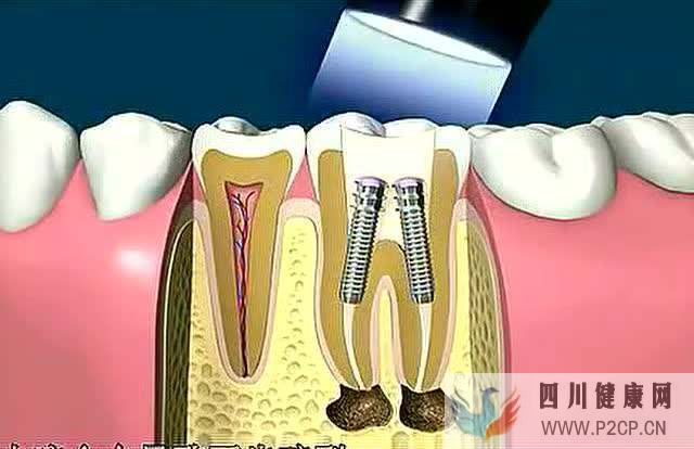 牙髓干细胞在口腔疾病治疗中的应用(图2) 牙髓干细胞在口腔疾病治疗中的应用(图2)
