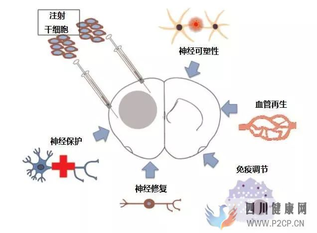 帕金森患者有救了?干细胞移植疗法效果感人,医学界的又一突破!(图1) 帕金森患者有救了?干细胞移植疗法效果感人,医学界的又一突破!(图1)