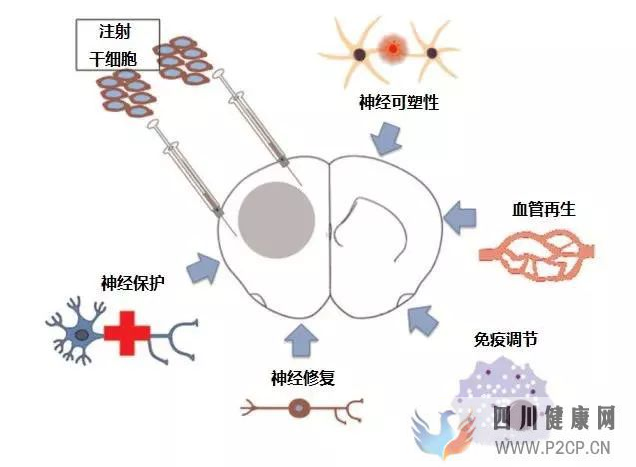 帕金森患者有救了？干细胞移植疗法效果感人，医学界的又一突破！(图1)