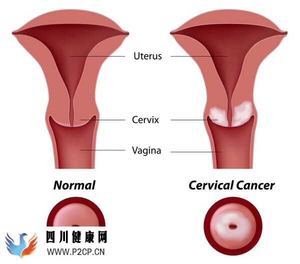 九价HPV疫苗降价！为什么有人打了，还患上宫颈癌？(图8)