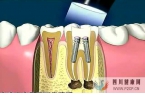 牙髓干细胞在口腔疾病治疗中的应用